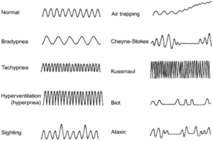 Vital Signs Monitoring using mmWave Technology | Mistral Blog